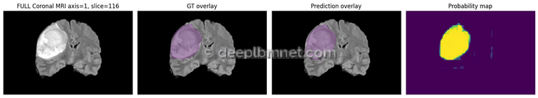 3D Medical Image Segmentation